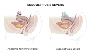 Endometriosis